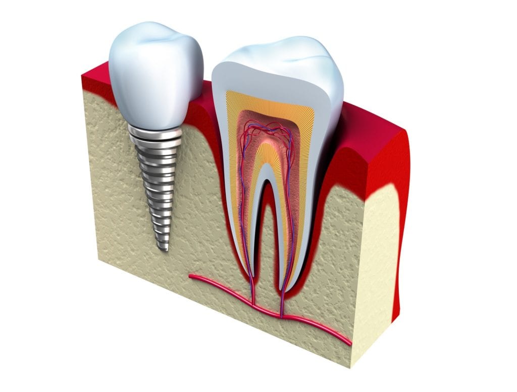 Dental Implants in Highland Park IL