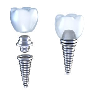 Dental implant crown highland park il