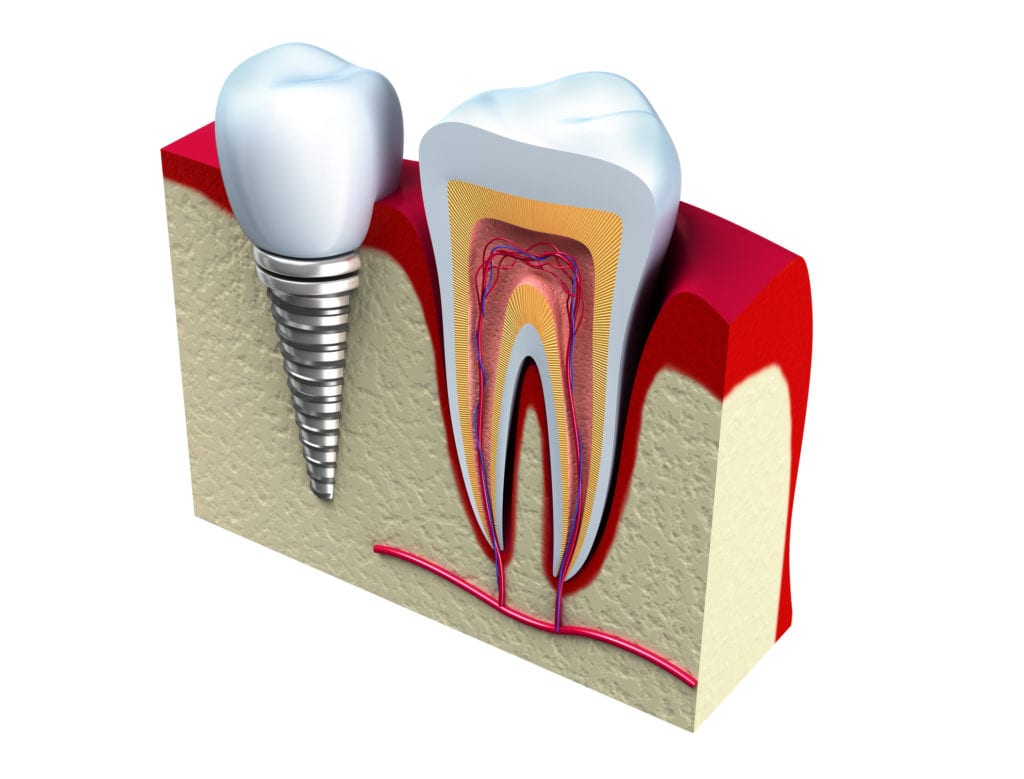 Single Dental Implants in Skokie, IL