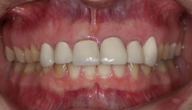 Before Treating Shortened Teeth in Skokie, IL