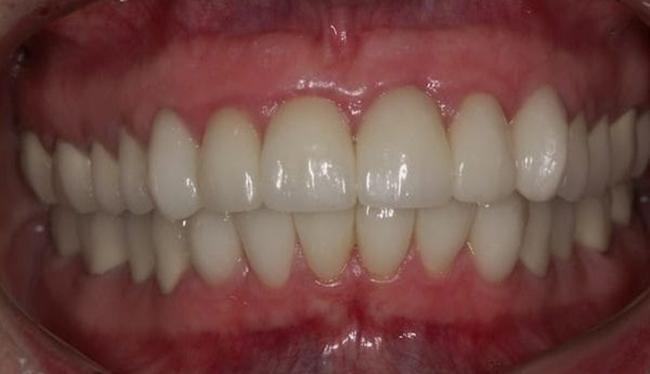 After Creating Fuller Teeth in Skokie, IL