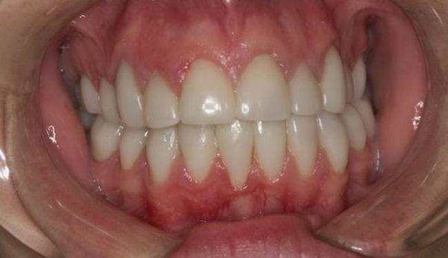 After Cosmetic Dentistry in Skokie, IL