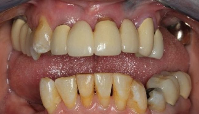 Before Gum Recession in Skokie, IL