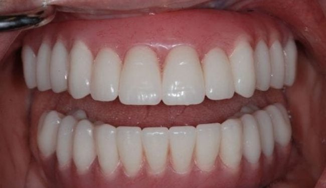 After Restorative Dental Care in Skokie, IL