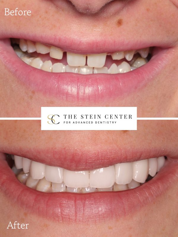 dental implants vs dentures