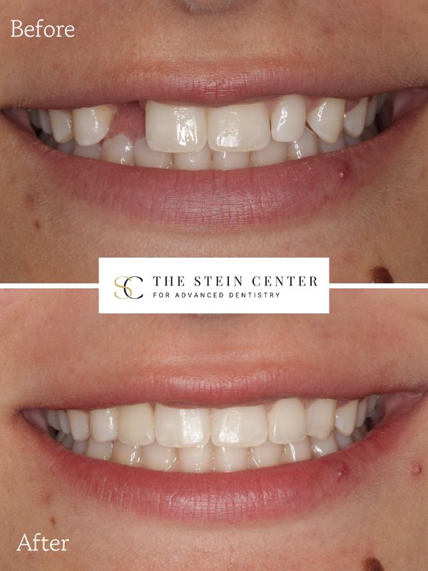 Dental patient before and after implants in Skokie IL